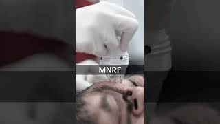 Micro needling Treatment For Acne Scars MNRFFlawlessSkin [upl. by Alhahs]