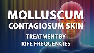 Molluscum Contagiosum Skin  RIFE Frequencies Treatment  Energy amp Quantum Medicine Bioresonance [upl. by Radley]