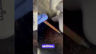 PRP Treatment For HAIR LOSS [upl. by Tasiana]