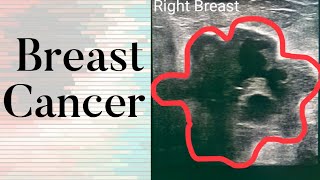 Breast Cancer  What Does Breast Cancer Look Like on an Ultrasound [upl. by Waligore295]