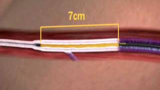 The VNUS Closure Procedure Using ClosureFAST Catheter [upl. by Averir]