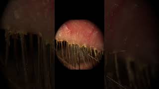 Demodex  Eye Mites [upl. by Drugi]