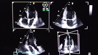 Triplane Echokardiographie triplane echocardiography [upl. by Pratt]