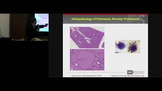 Alveolar Macrophage Dysfunction in Lung Disease  Stewart Levine [upl. by Lamaj692]