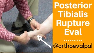 Posterior Tibialis Rupture Evaluation [upl. by Aggri]