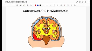 SUBARACHNOID HEMORRHAGE [upl. by Harvey312]