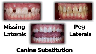 Missing Laterals Canine Substitution Peg Laterals httpswwwstraightsmilesolutionscom [upl. by Solracnauj]