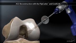 ACL Reconstruction with the FlipCutter and GraftLink [upl. by Pool499]