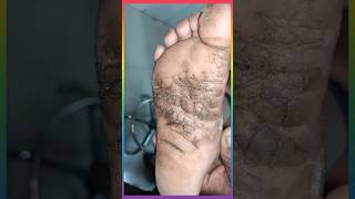 पैरो के तलवे की चमडी का रोग plantar keratoderma viralshorts [upl. by Teillo834]