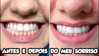 ANTES E DEPOIS DO MEU SORRISO Clareamento a laser com restauração estética [upl. by Rajewski]