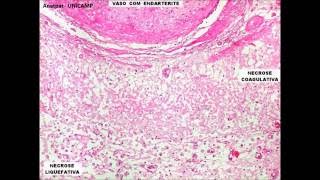 Monitoria  Inflamação Patologia [upl. by Radack]