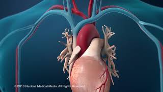 Coronary Artery Angioplasty Radial Access  Hindi [upl. by Ben]