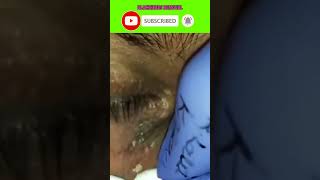 Blackheads Treatments Blackhead Removal Blackhead Treatment Blackhead Extraction Blackheads shorts [upl. by Llewellyn]