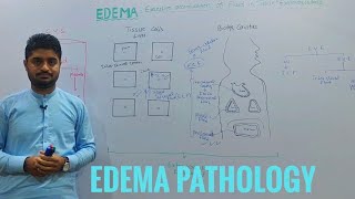 EdemaOedemaEdema pathologyintroduction to edema [upl. by Nivat]