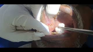 Leukoplakia toungue Cautery Laser  Dr Hitesh Patel [upl. by Hsur137]