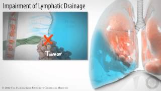 Pleural Space Part 3 of 3 Pleural Effusions HD [upl. by Yoshi546]