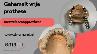 Gehemelte vrije prothese telescoopprothese kunstgebit zonder gehemelte [upl. by Oalsecnew]