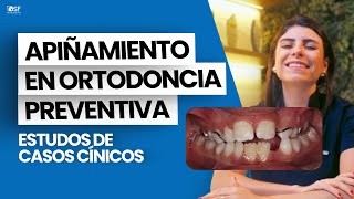 CASOS CLÍNICOS DE APIÑAMIENTO EN ORTODONCIA PREVENTIVA [upl. by Ehsiom]