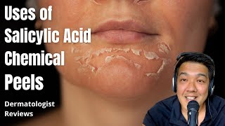 Salicylic Acid Peels  Indications [upl. by Ycniuqal]