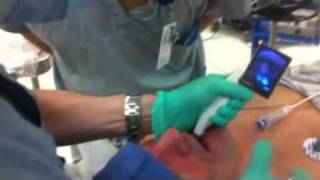 McGRATH MAC Video Laryngoscope  intubation 1 [upl. by Rosario894]