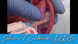 Temporary Crowns Quick and Easy Fabrication  Dental Minute with Steven T Cutbirth DDS [upl. by Naibaf]