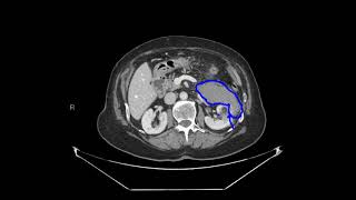 Renal angiomyolipoma with acute hemorrhage [upl. by Bradly643]