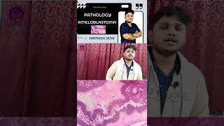 Ameloblastoma  Human Pathology  Full video available in the channel dental [upl. by Yetti]