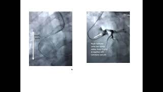 Coronary catheter techniques 1 focus on transradial approach Elias Hanna Univ Iowa [upl. by Hobbs]