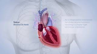 Biotronik pacemaker [upl. by Ettennyl]