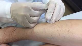 Varicose Vein Treatment  George Anton MD [upl. by Lekkim]