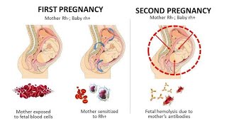 Hemolytic Disease of Newborn resulting to Alloimmune Hemolytic Anemia [upl. by Zetnom]