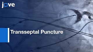 Transseptal Puncture with Cryoballoon Ablation Catheter Operation  Protocol Preview [upl. by Zahara]