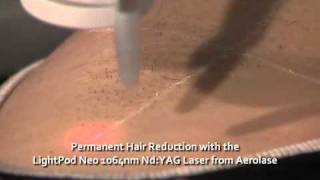 Laser Hair Removal Underarm  The LightPod Neo 1064nm Laser by Aerolase [upl. by Pitt]