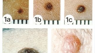 NonMelanoma Skin Cancers  Skin Cancer [upl. by Haldi]