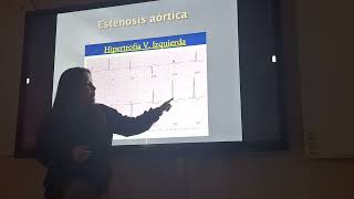 Cardiología  Estenosis aortica e Insuficiencia Aortica [upl. by Kassandra]