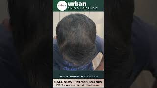 Unbelievable Results Of PRP For Hairloss  Urban Skin amp Hair Clinic [upl. by Shelba]