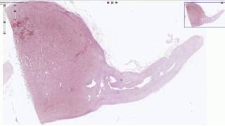 Pheochromocytoma  Histopathology [upl. by Worsham]