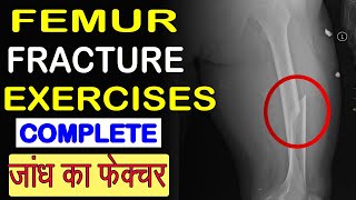 FEMUR FRACTURE EXERCISES COMPLETE  HEALTH MADE EASY [upl. by Roxi]