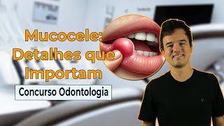 MUCOCELE Dicas de OURO para CONCURSOS de ODONTOLOGIA [upl. by Llemej765]