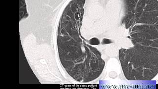 Chest xray Bronchiectasis on CT and Chest xray [upl. by Cates]