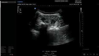 Lumbar erector spinae twitching response ultrasound guide epidural block L45 loss of resistance [upl. by Leik]