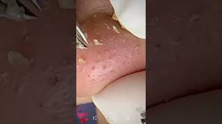 Skincare  Blackheads Removal 091 skincare skincare blackheads blackheads [upl. by Nnahteb58]