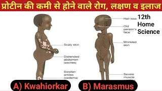 प्रोटीन की कमी से होने वाले रोग लक्षण व इलाज  Kwashiorkor disease  Marasmus disease [upl. by Enovad]