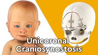 What is Unicoronal Craniosynostosis Surgery [upl. by Ak]