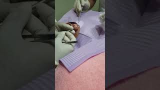 Surgical removal of a large earlobe cyst surgery pimple popper timelapse video [upl. by Selry]