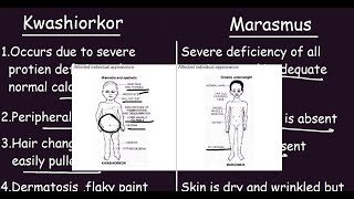 Kwashiorkor vs Marasmus Quick Differences amp Comparison [upl. by Rosmunda]