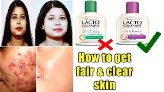 Lacto Calamine lotion reviewusesbenefitshow to get clear and fair skin [upl. by Aloivaf]