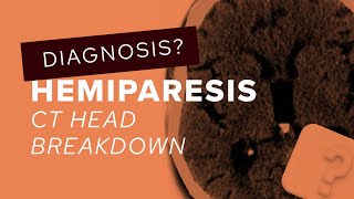 CT Head breakdown how to assess for acute stroke on CT [upl. by Vivia]