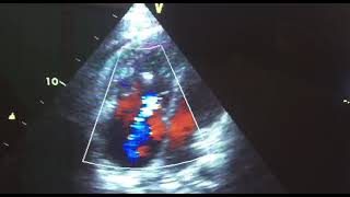 Right ventricular dualthrombi attaching to the chordae tendineae a case report [upl. by Ralf]