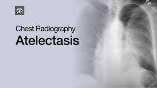 Chest Radiography Atelectasis [upl. by Loris251]